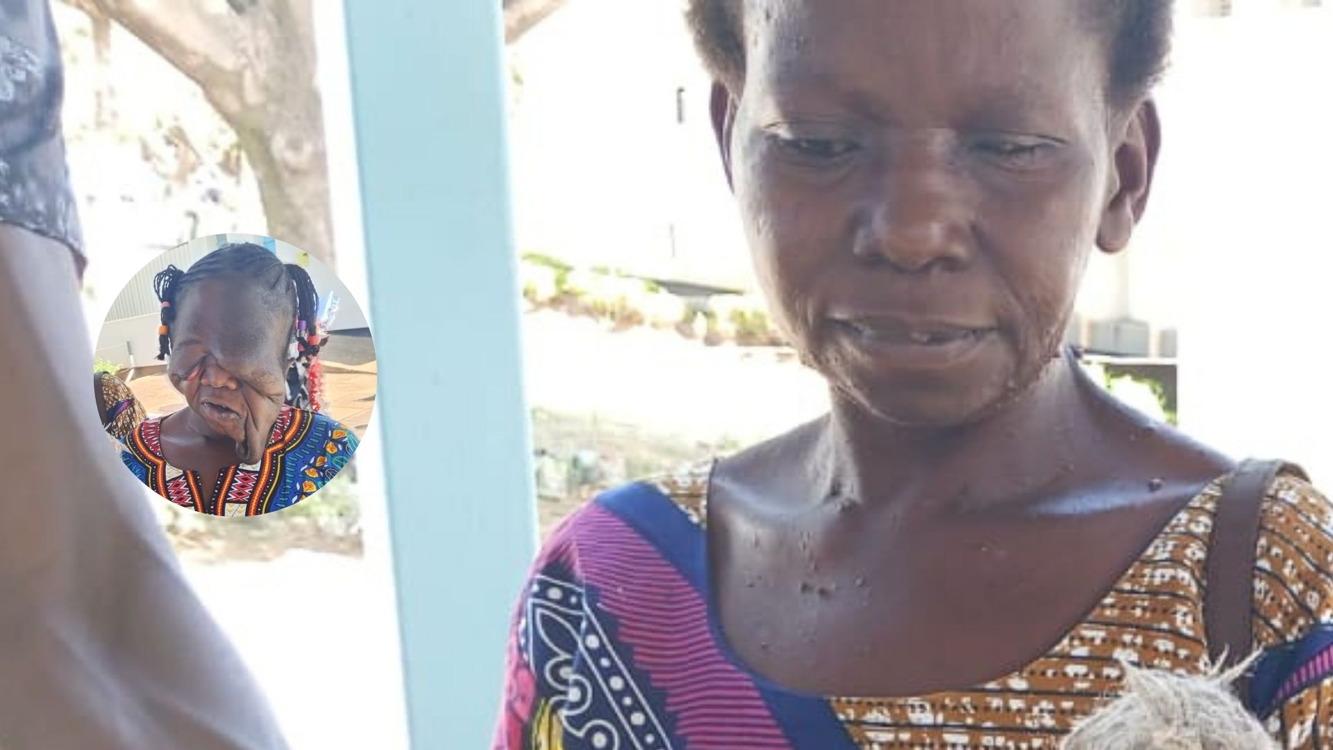 Devastating eye disease